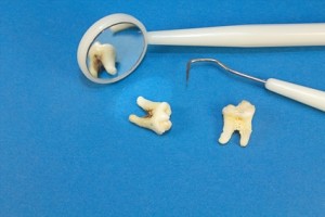 Die Behandlung einer Zahnwurzel