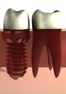 Zahnwurzel neben Teilprothese