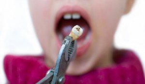 Gezogener Zahn wegen Karies