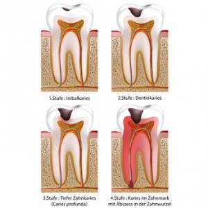 4 Stufen des Karies im Zahn