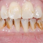 Zähne ohne Prophylaxe