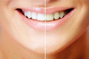 Zahn Bleaching - Vorher und Nachher