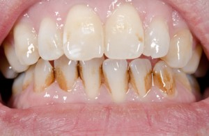 So sehen gelbe Zähne mit Belägen aus