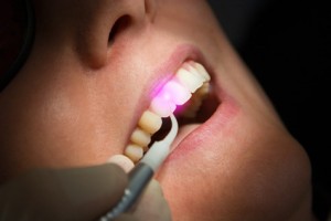 Dental Laser Wurzelbehandlung