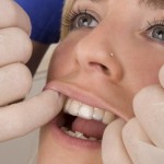 Zahnaufhellung beim Zahnarzt