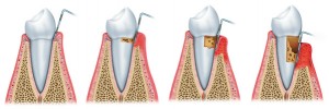 So entsteht die Gingivitis