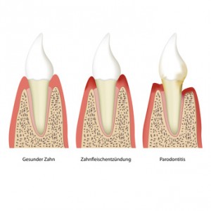 Entstehung von Parodontose