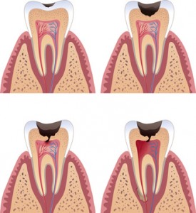 Pulpitis entsteht nach Karies