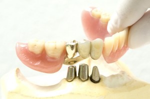 Zahn-Prothese hochgehoben