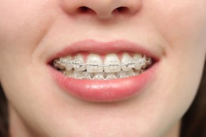 Klassische Zahnspange mit Metall